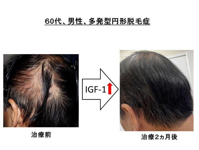 円形脱毛症　病院
